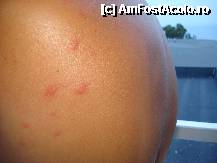 [P08] urticaria cu care m-am ales de la mancarurile'superspeciale' si proaspete » foto by simonabrasov
 - 
<span class="allrVoted glyphicon glyphicon-heart hidden" id="av252332"></span>
<a class="m-l-10 hidden" id="sv252332" onclick="voting_Foto_DelVot(,252332,9086)" role="button">șterge vot <span class="glyphicon glyphicon-remove"></span></a>
<a id="v9252332" class=" c-red"  onclick="voting_Foto_SetVot(252332)" role="button"><span class="glyphicon glyphicon-heart-empty"></span> <b>LIKE</b> = Votează poza</a> <img class="hidden"  id="f252332W9" src="/imagini/loader.gif" border="0" /><span class="AjErrMes hidden" id="e252332ErM"></span>